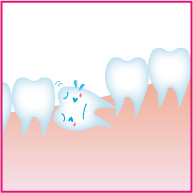埋状歯の治療